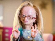 غیرمعمولی جینیاتی بیماری میں مبتلا 15 سالہ یوٹیوبر چل بسیں