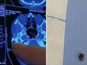 20 سال بعد ایک شخص کے سرسے گولی نکال دی گئی