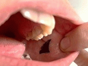 گال کے اندر چپکائے جانے والے انسولین اسٹیکر