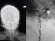 جعلی پیر نے بیٹے کی خواہش مند حاملہ خاتون کے سر میں کیل ٹھوک دی