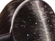 سر کی خشکی سے کیسے چھوٹے جان