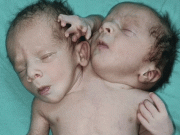 بھارت میں دو سر اور تین ہاتھوں والے بچے کی پیدائش