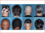 گٹھیا کی عام دوا گنج پن کےعلاج میں مؤثر ثابت