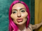 یوکرین کی ماڈل نے دنیا کے سب سے بڑے گال رکھنے کیلئے سرجری کروالی