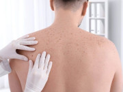 رواں سال 34 لاکھ امریکی جلد کے کینسر میں مبتلا ہوسکتے ہیں رپورٹ