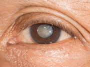 آنکھ میں موتیا ختم کرنے والے دوا کی چوہوں پر کامیاب آزمائش