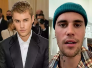 امریکی گلوکار جسٹن بیبر فالج میں مبتلا ہوگئے