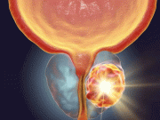 بلند شدت کی الٹراساؤنڈ سے پروسٹیٹ کینسر کے علاج میں اہم پیشرفت
