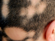 بالوں کی نمو اور مدافعتی نظام کے درمیان حیران کن تعلق دریافت