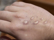 ڈبلیو ایچ او نے منکی پاکس کے حوالے سے وارننگ جاری کردی