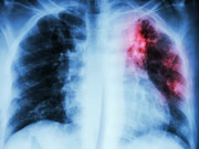برطانیہ میں پھیپھڑوں سے ہونے والی اموات کا سبب کم آمدنی قرار