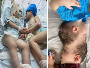 کامیاب آپریشن کے بعد سر سے جُڑے بھائیوں نے پہلی بار ایک دوسرے کو دیکھا