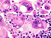 بڑھتا درجہ حرارت جِلد کے سرطان کے کیسز میں اضافہ کرسکتا ہے ماہرین