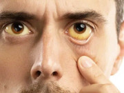 یرقان انسانوں کے لئے کیوں خطرناک ہے