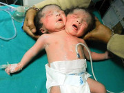 بھارت میں 2سرایک جسم والے بچے20روز ہی زندہ رہ سکے