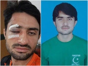 ہاکی ٹریننگ کیمپ میں کھلاڑی آنکھ پر گیند لگنے سے زخمی