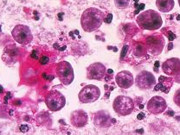 کراچی میں رواں سال نگلیریا سے 12 ویں موت کی تصدیق