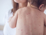 کراچی؛ سرد موسم کی شدت بڑھتے ہی بچوں میں خسرہ پھیلنے لگا 