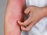 کراچی میں گرمی کی شدت کے سبب جِلدی امراض میں اضافہ