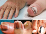 انگلی کے ناخن کا مخصوص نشان جلدی کینسر کی علامت