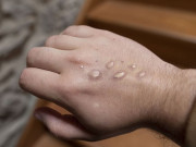 کراچی میں منکی پاکس کا مشتبہ کیس سامنے آگیا