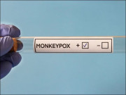 خیبرپختونخوا میں ایم پاکس کے مزید دو کیسز سامنے آگئے