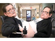 امریکا کے دھڑ جڑے بھائی ڈونی اور ٹونی 62 سال کے ہوگئے 