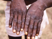 سندھ میں منکی پاکس کا پہلا مشتبہ کیس سامنےآگیا