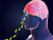 کراچی  دماغ خور جرثومہ نگلیریا ایک اور جان لے گیا