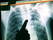 بچوں میں تپ دق کی شرح میں کئی گنا اضافہ ہوگیا