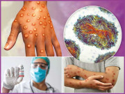 منکی پاکس کی علامات اور حفاظی تدابیر