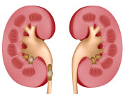 گلوبل وارمنگ گردوں میں پتھری کا سبب بن رہی ہے 