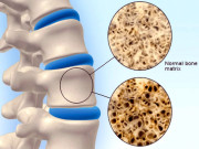 آسٹیوپوروسس  