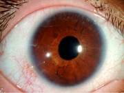 بصارت کی کم زوری وجوہات اور علامات