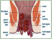 بواسیر کے تکلیف دہ اثرات کو کم کیا جا سکتا ہے