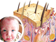 ارٹیکیریا جسم میں ہسٹامائن کی مقدار بڑھنے سے جنم لینے والا جلدی مرض