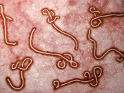 ایبولا وائرس کے باعث موت سے بچ جانیوالے مریض اندھے پن کا شکارہورہے ہیں عالمی ماہرین صحت