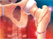 صحت کا اہم مسئلہ  گنٹھیا یا جوڑوں کے درد