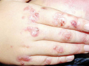 ایپی ڈرمولائسس بولوسا ایسا مرض جس میں جسم پر چھالے پڑ جاتے ہیں