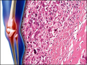 اوسٹیوسرکوما یہ مرض گھٹنے اور کہنیوں کی ہڈیوں کو متاثر کرتا ہے