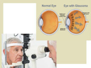 آنکھوں کے اس شفاف سیال کی خرابی بصارت سے محروم کرسکتی ہے