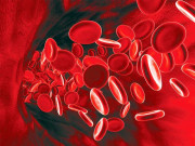 خون میں موجود پروٹین کی خرابی کے باعث پیدا ہونے والی بیماری