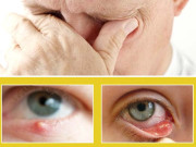 آنکھوں کے دانے   گھریلو علاج اور چند احتیاطیں