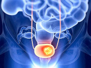 وٹامن ڈی کی کمی سے مثانے کے کینسر کا خطرہ بڑھ سکتا ہے تحقیق