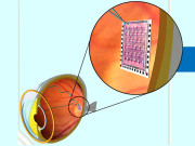 مصنوعی ریٹینا  
