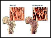 ہڈیوں کا بُھربُھراپن ’اوسٹیو پوروسیس‘