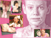 جلد کا سنگین مرض  ’ایپی ڈرمولیسس بلوسا‘