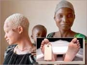 تنزانیہ سُورج مُکھی افراد البائنوز کے بعد عورتوں کی قتل گاہ بن گیا