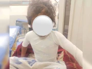 لاہور؛ ساتھ جانے سے انکار پر سوتیلے باپ نے 5سالہ بچی پر تیزاب پھینک دیا