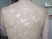 جِلد کے کینسر کی تشخیص کرنے والا زبردست اے آئی ماڈل متعارف